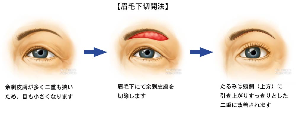眉毛下切開法の３つの手順