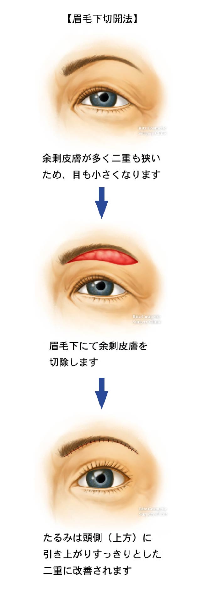 眉毛下切開法の３つの手順