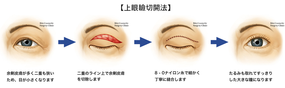 上眼瞼切開法　4つの手順