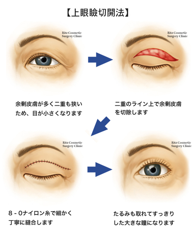 上眼瞼切開法　4つの手順