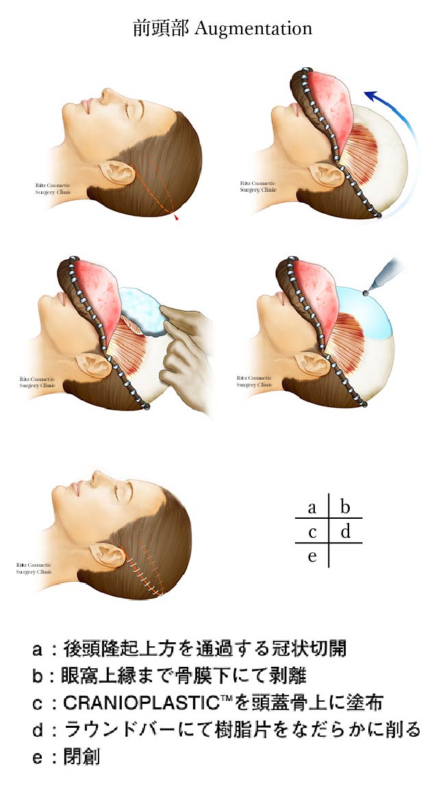 前頭部の手術手順