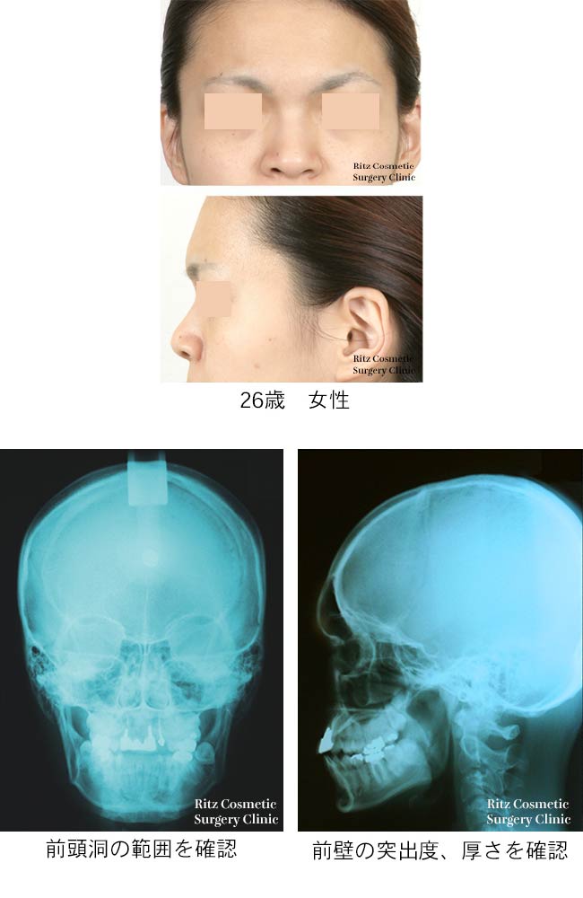 26歳女性の前頭洞の範囲を確認、前壁の突出度、厚さを確認