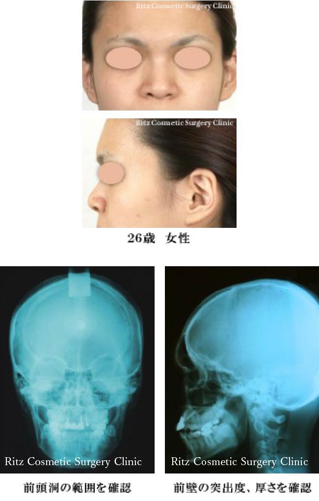 26歳女性の前頭洞の範囲を確認、前壁の突出度、厚さを確認