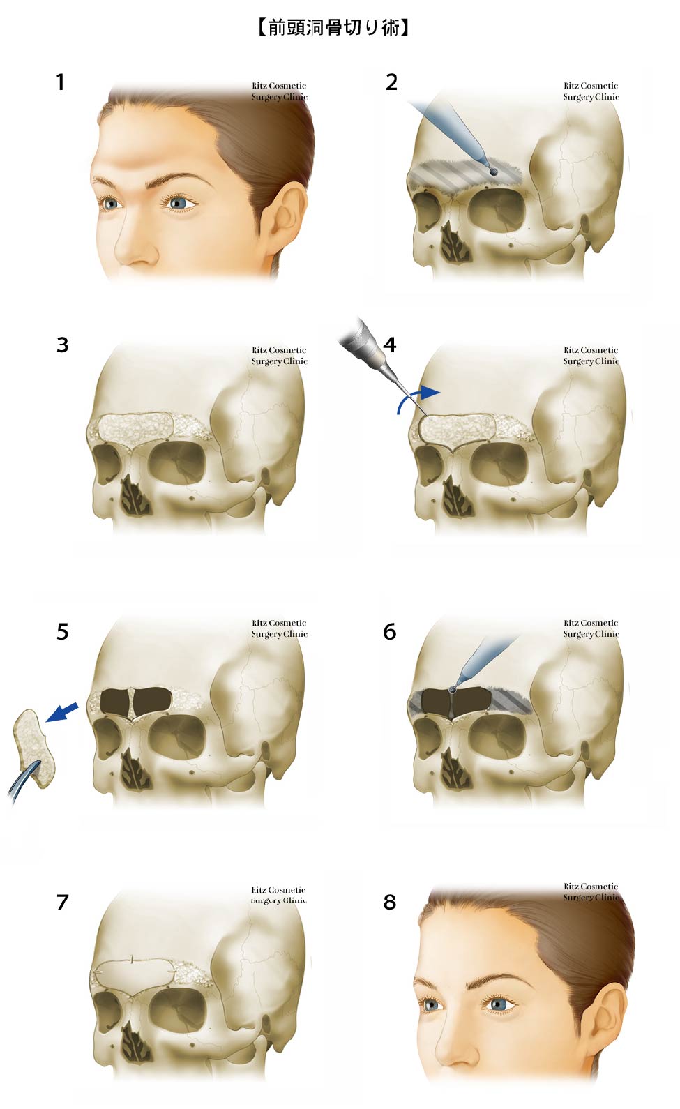 前頭洞骨切り術の手順