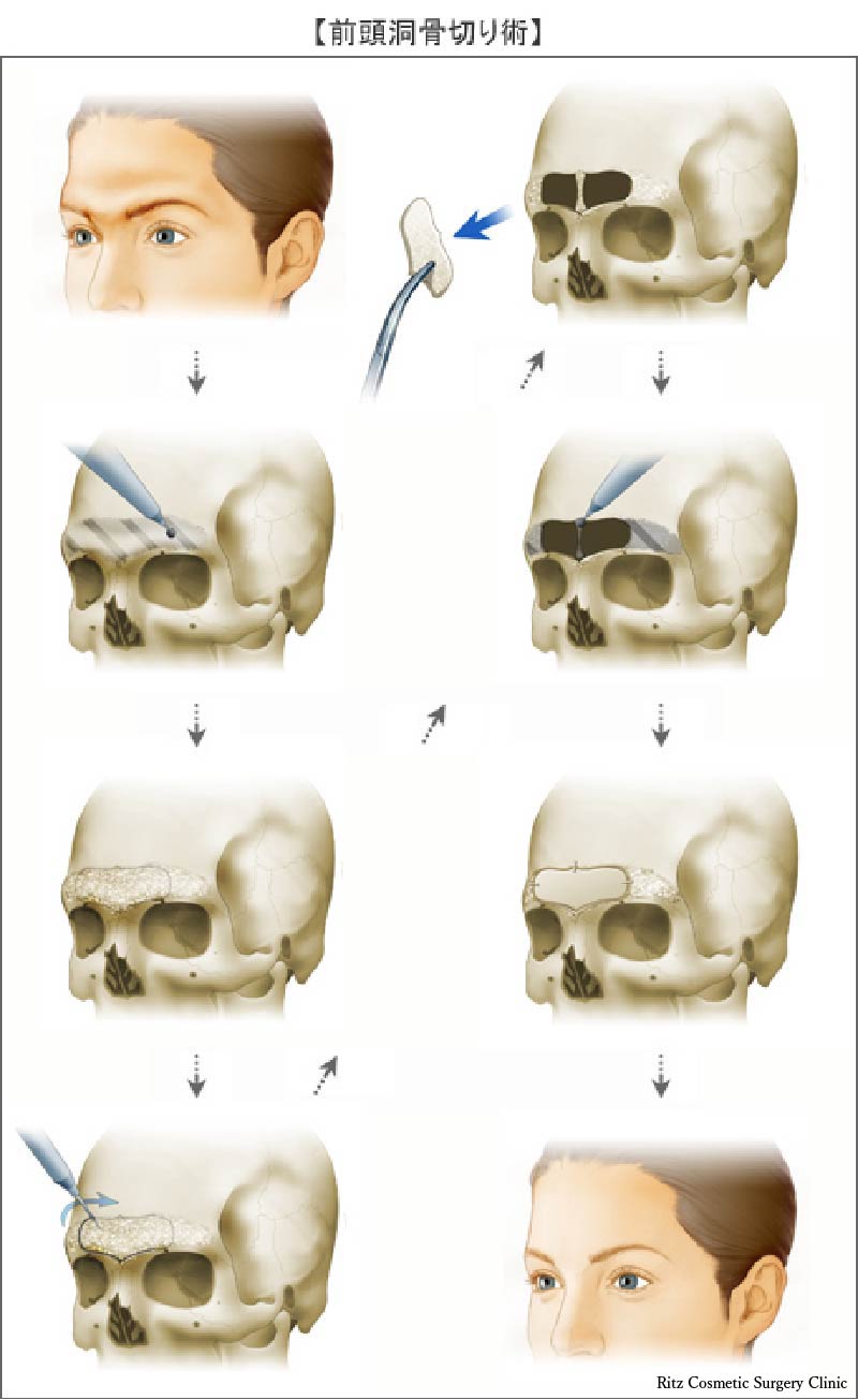 前頭洞骨切り術の手順