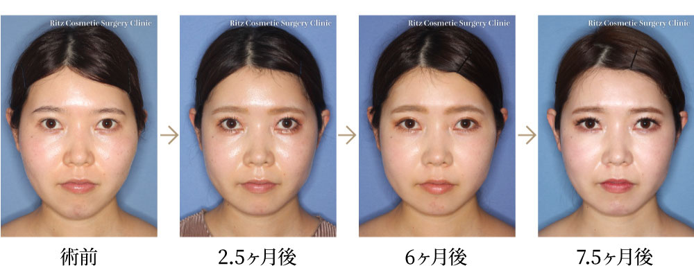 オトガイ水平骨切り（中抜き＋前進）＋頬骨骨切りの症例写真