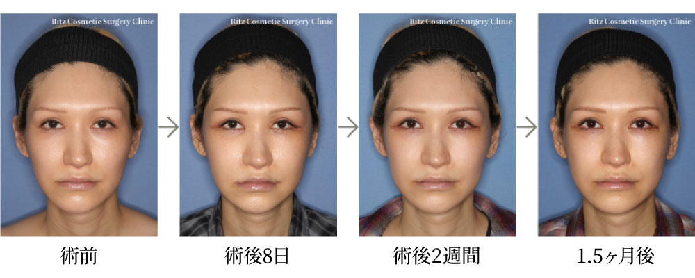 頬骨セットバック術の症例写真