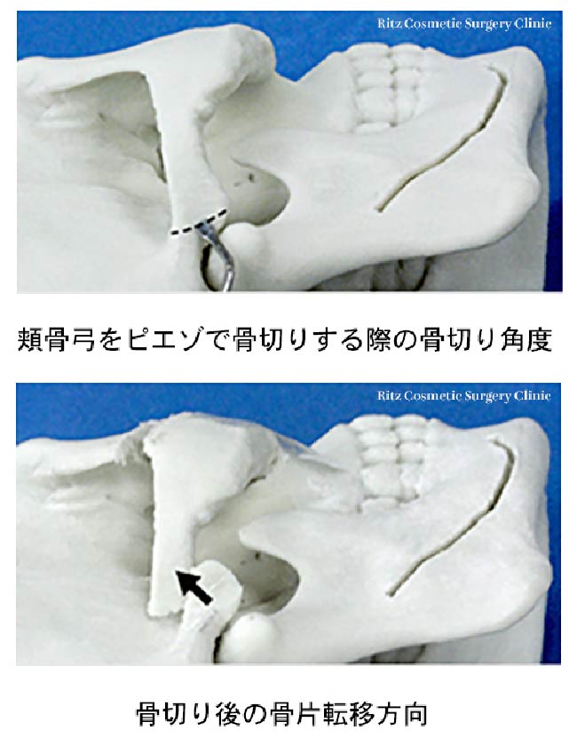 頬骨弓をピエゾで骨切りする際の骨切り角度と骨切り後の骨片転位方向