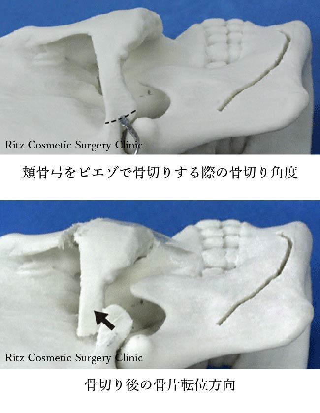 頬骨弓をピエゾで骨切りする際の骨切り角度と骨切り後の骨片転位方向