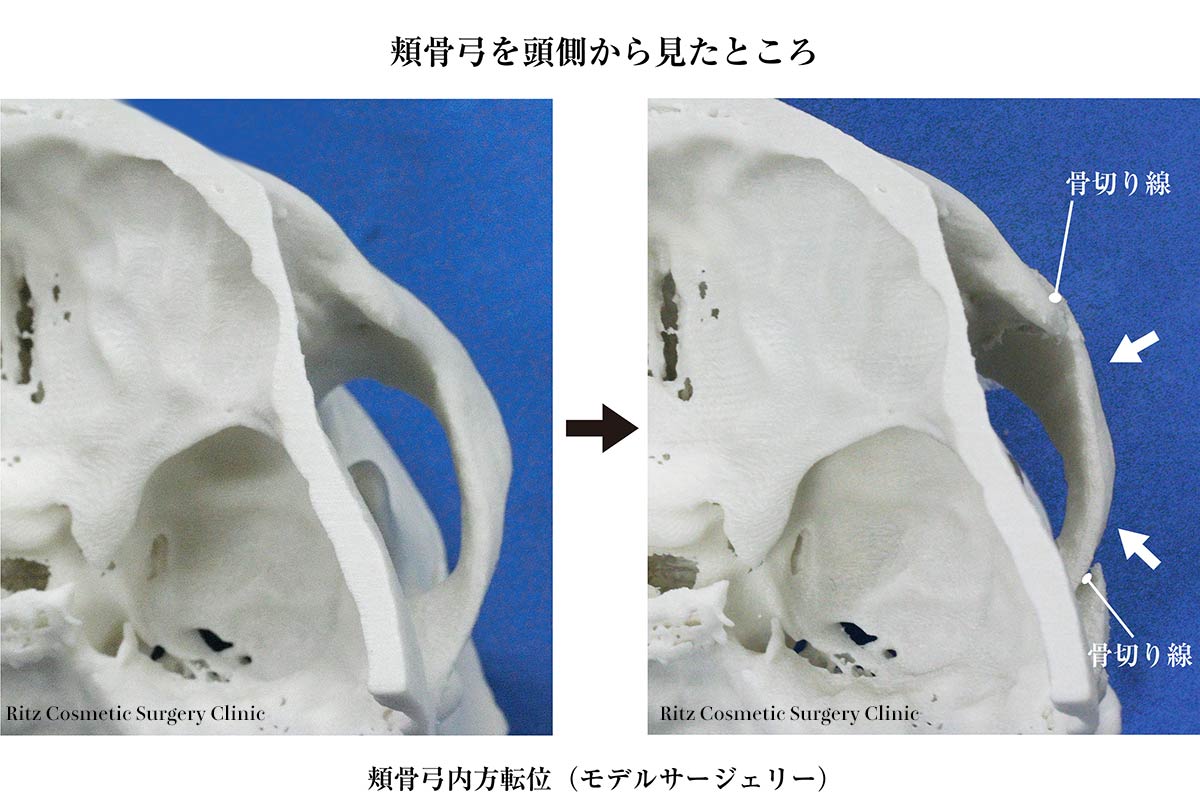 頬骨弓を頭側から見たところ