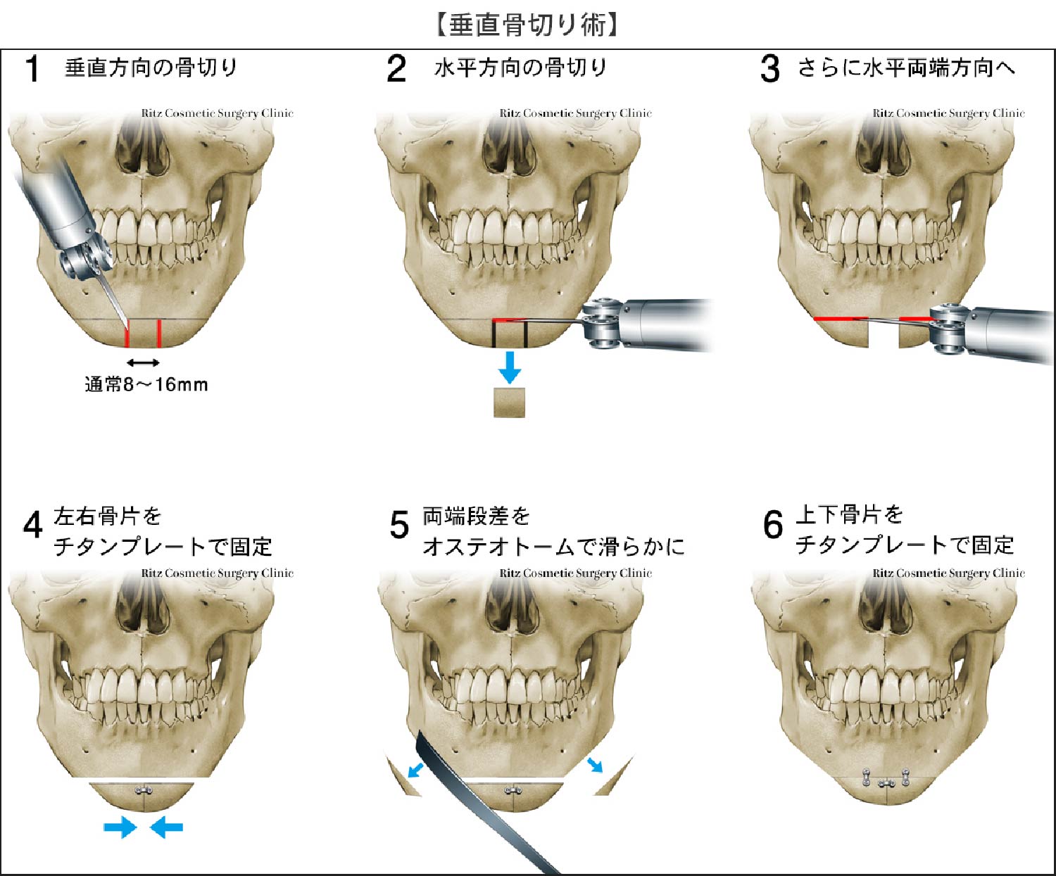 垂直骨切り術の６つの手順