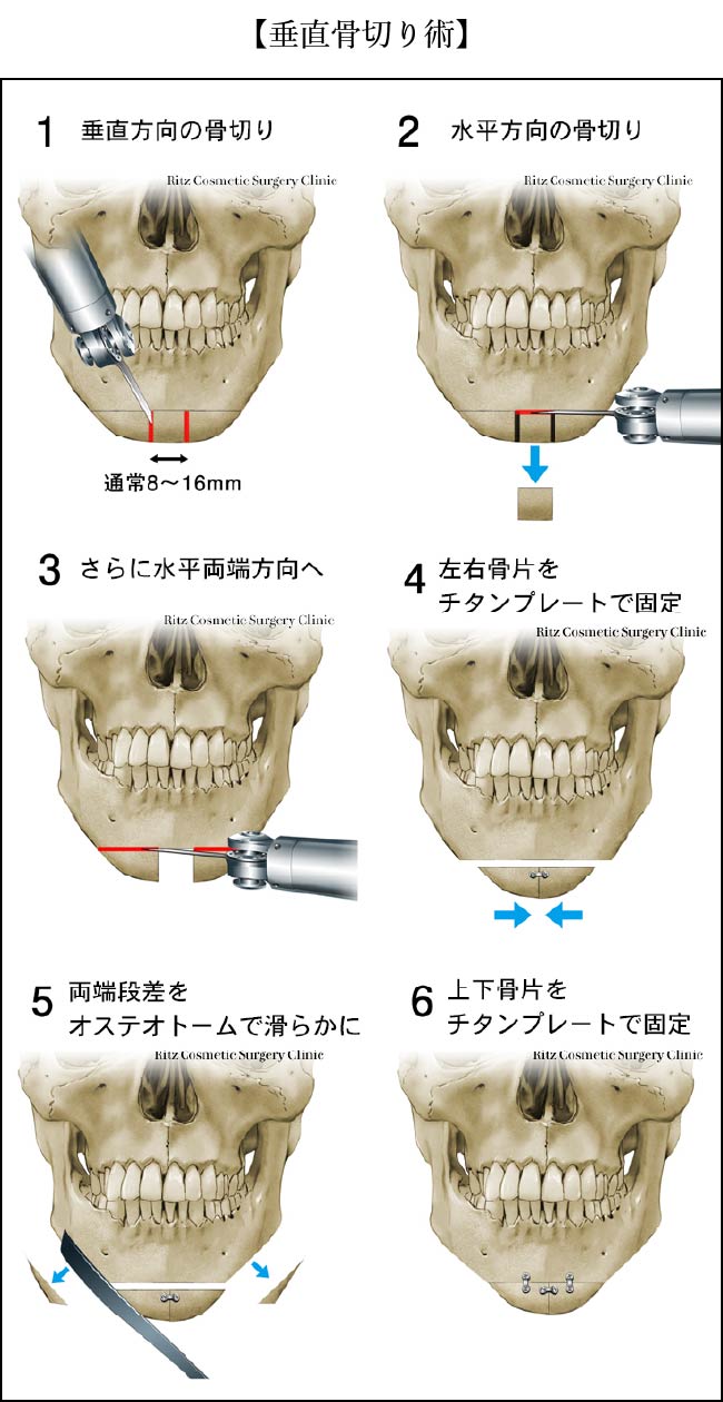 垂直骨切り術の６つの手順