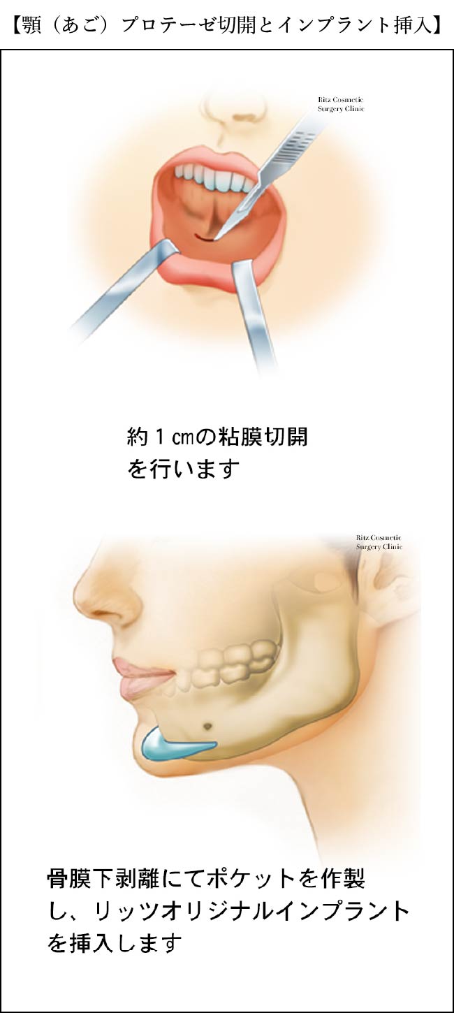 顎プロテーゼ切開とインプラント挿入