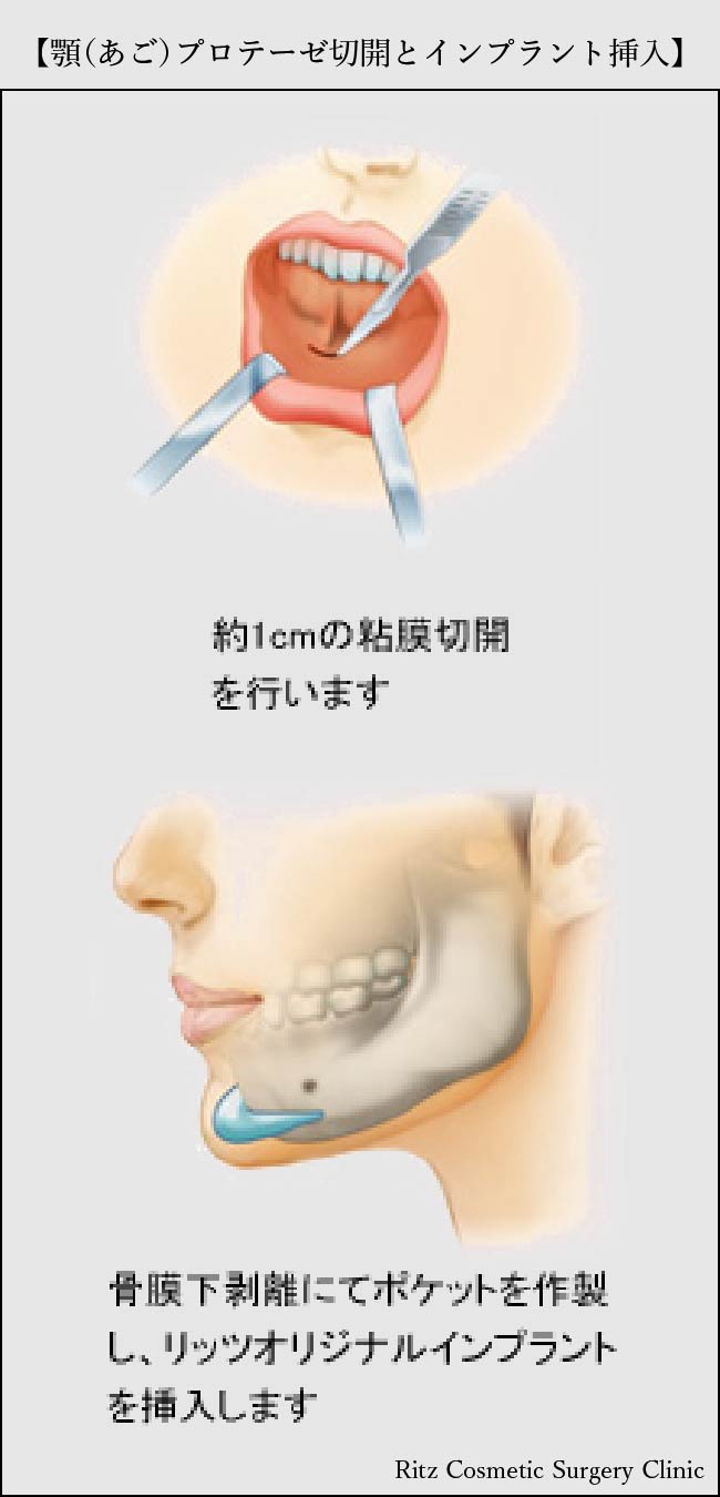 顎プロテーゼ切開とインプラント挿入