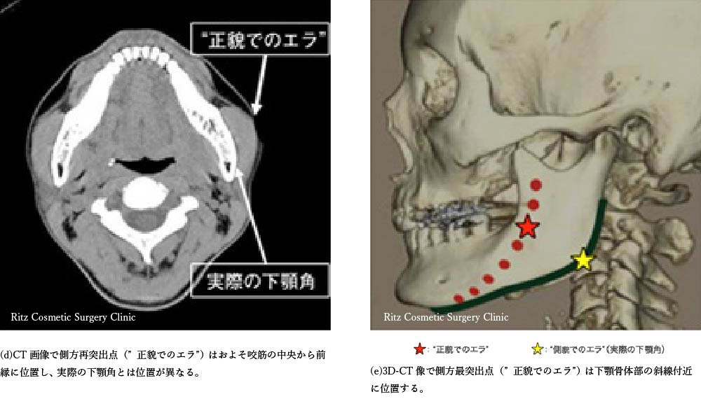 エラ(下顎角)の位置に対する誤解　(d)CT画像で側方再突出点（正貌でのエラ）はおよそ咬筋の中央から前縁に位置し、実際の下顎角とは位置が異なる。(e)3D-CT像側方再突出点（正貌でのエラ）は下顎体部の斜線付近に位置する
