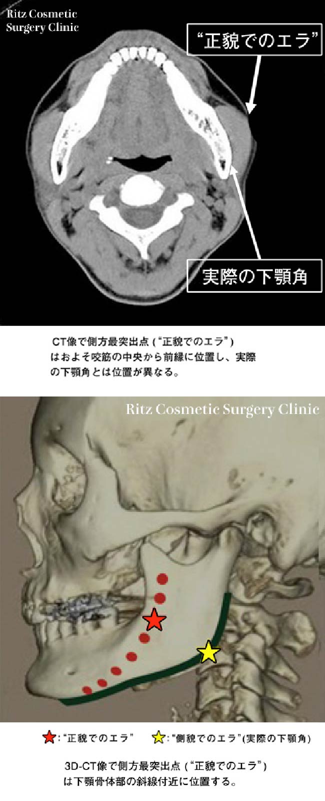 エラ(下顎角)の位置に対する誤解　(d)CT画像で側方再突出点（正貌でのエラ）はおよそ咬筋の中央から前縁に位置し、実際の下顎角とは位置が異なる。(e)3D-CT像側方再突出点（正貌でのエラ）は下顎体部の斜線付近に位置する