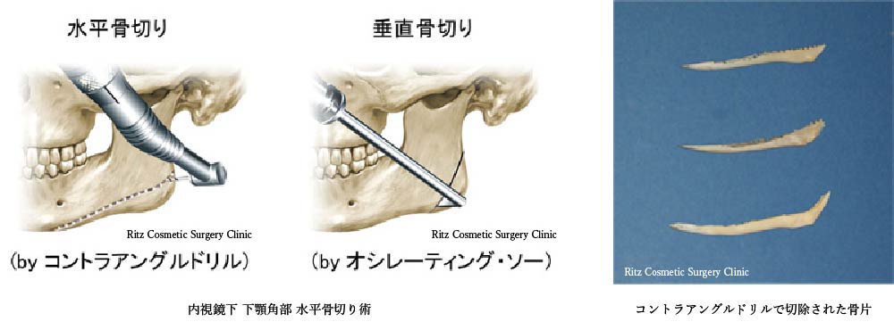 オシレーティング骨鋸の欠点、内視鏡下 下顎角部 水平骨切り術、コントラアングルドリルで切除された骨片