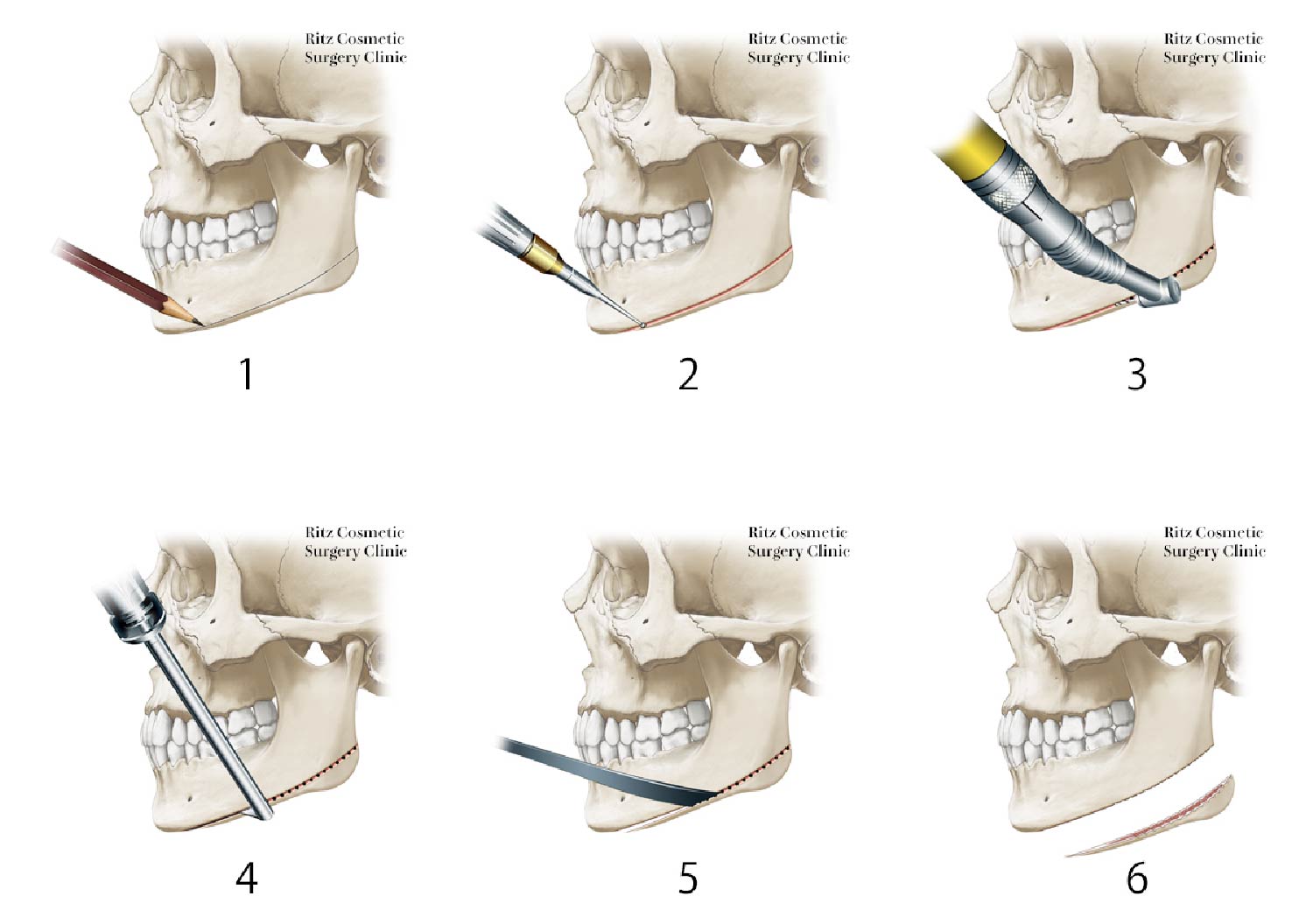 拡大下顎角骨切り術：横顔(側貌)改善術の手順