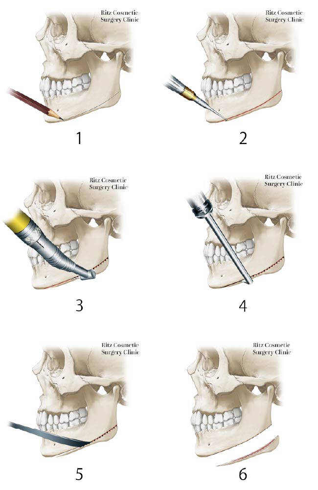 拡大下顎角骨切り術：横顔(側貌)改善術の手順
