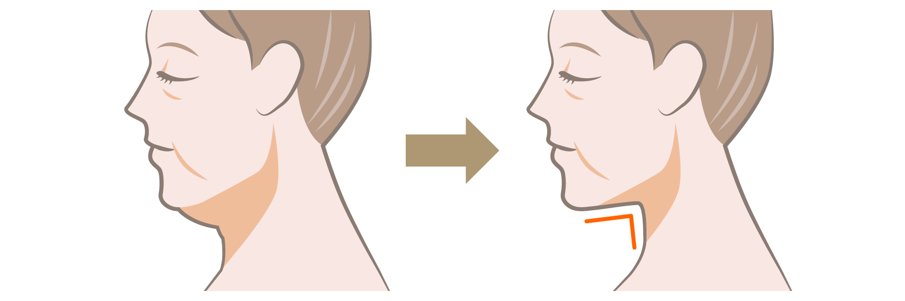 ペリカン手術（顎下筋肉縛り）とは