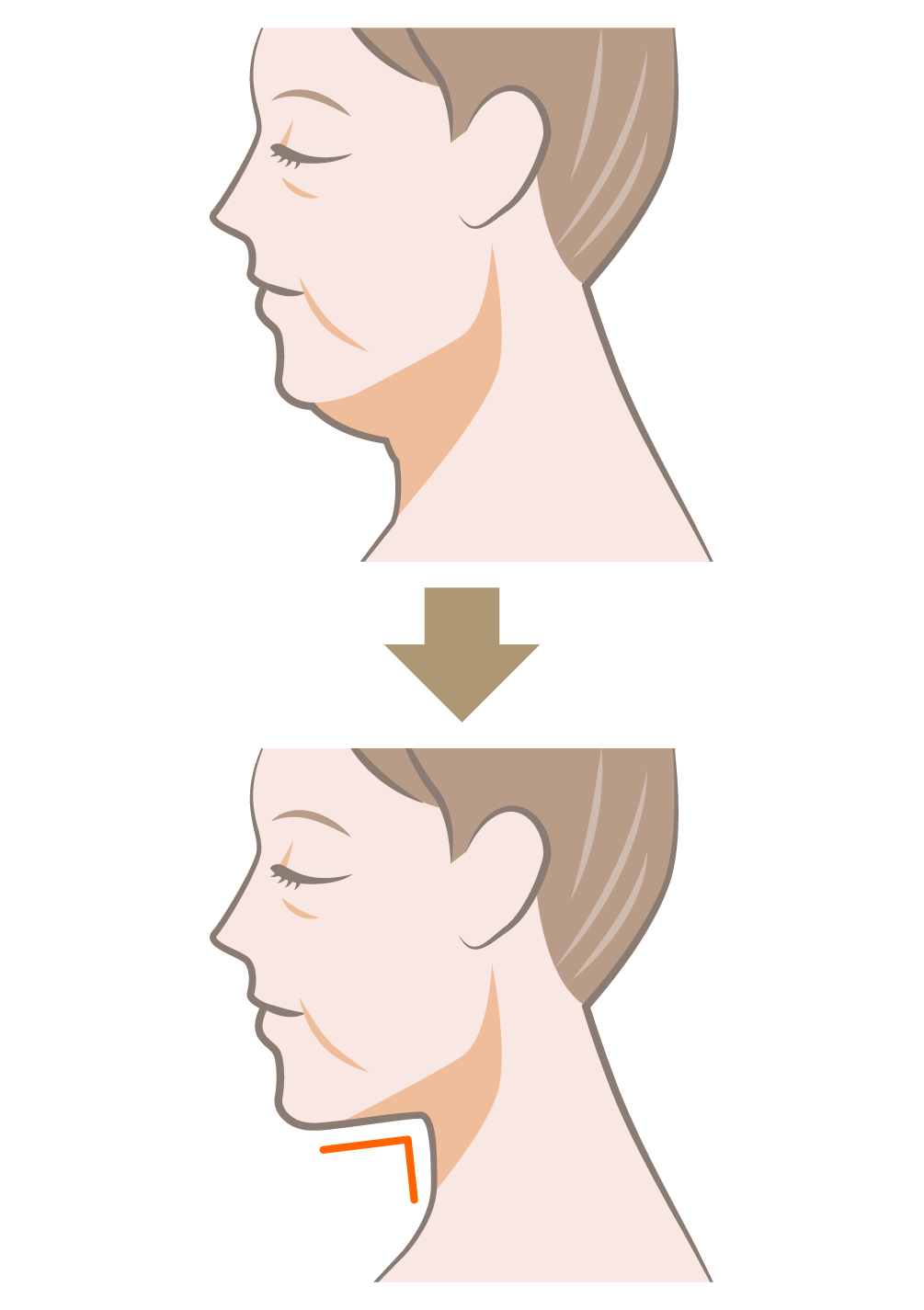 ペリカン手術（顎下筋肉縛り）とは