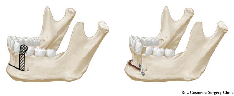下顎前歯部歯槽骨切り術