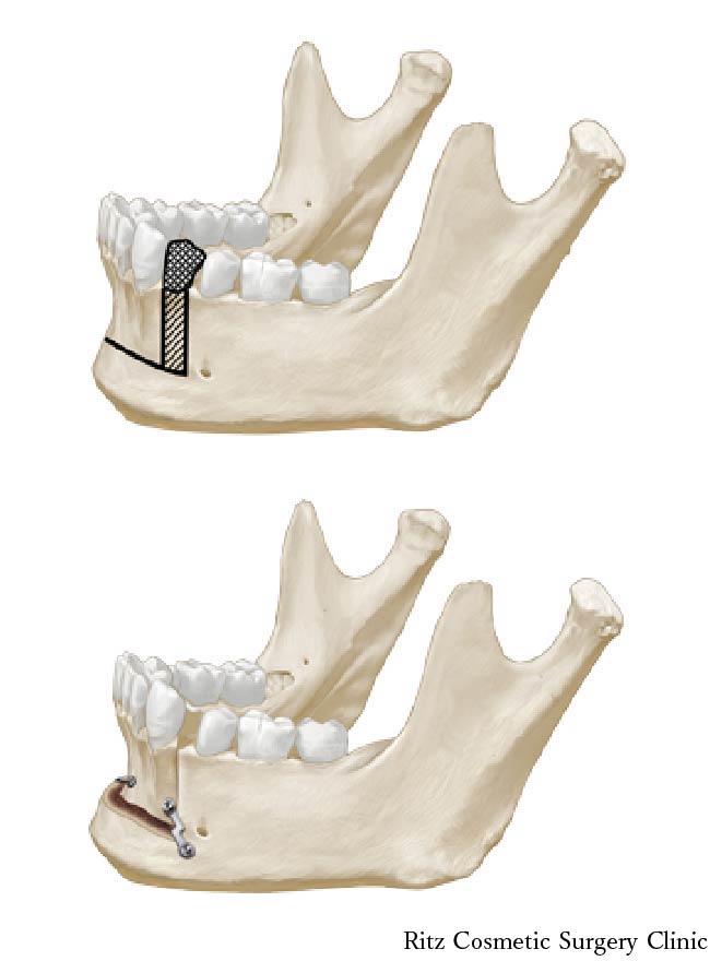 下顎前歯部歯槽骨切り術