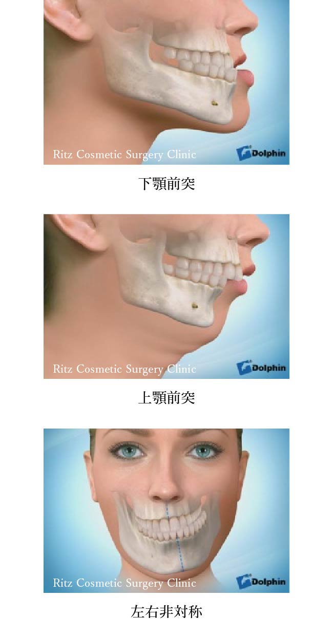 顎変形症（jaw deformity)３つの種類　下顎前突、上顎前突、左右非対称