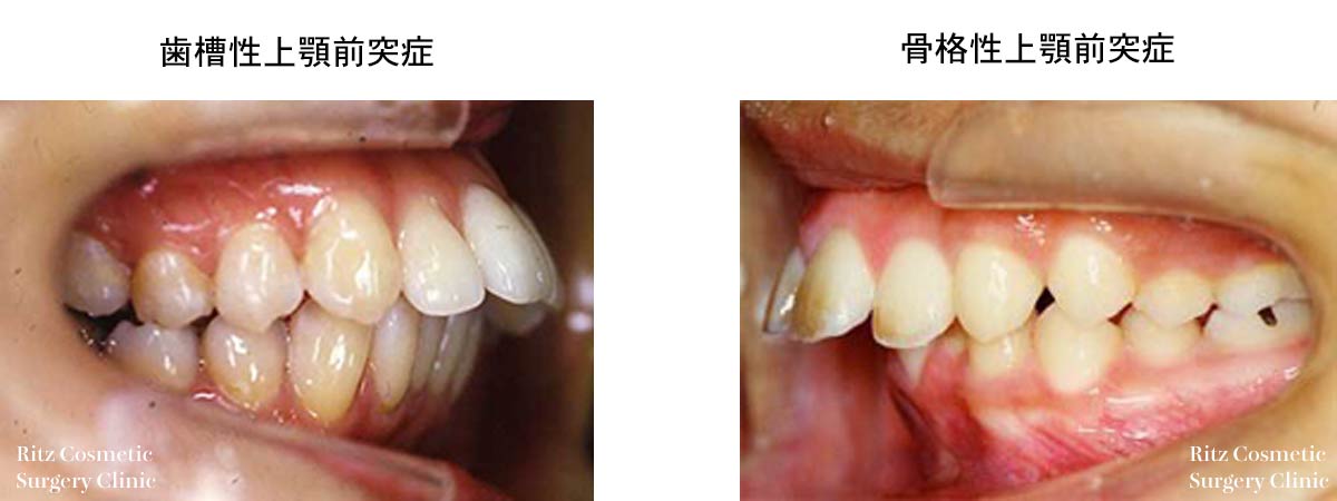 上顎前突症の分類 歯槽性上顎前突症、骨格性上顎前突症