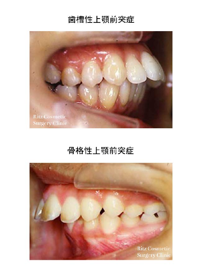上顎前突症の分類 歯槽性上顎前突症、骨格性上顎前突症