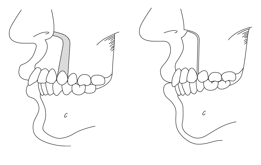 上顎前歯部歯槽骨切り術