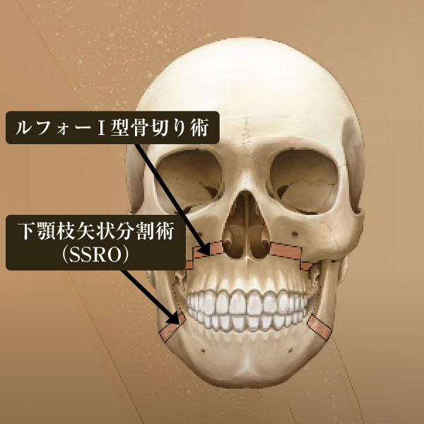 両顎手術（LeFort I/ルフォー＋SSRO）とは