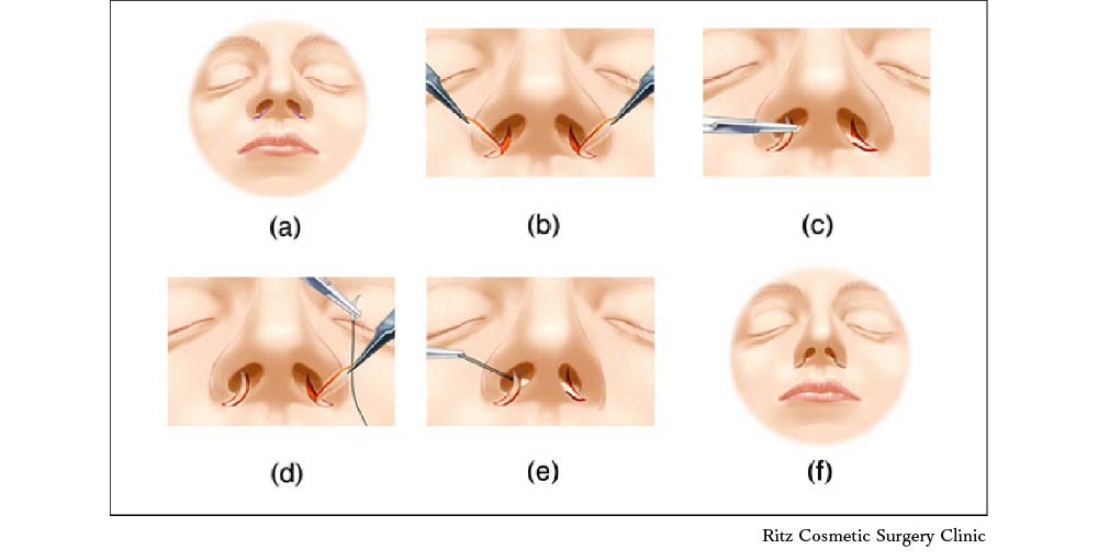 東京院 院長広比の開発した鼻の手術法に関する論文