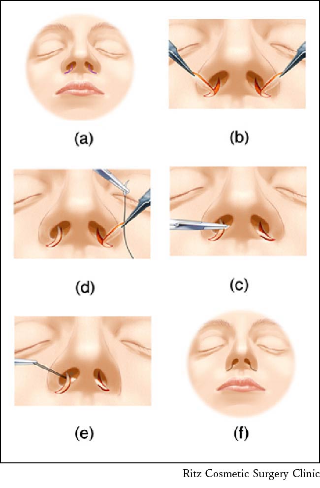 東京院 院長広比の開発した鼻の手術法に関する論文
