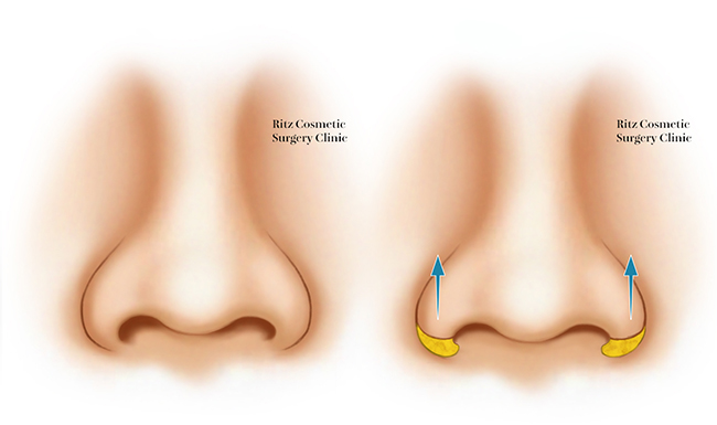 鼻翼挙上術：鼻翼基部が鼻柱基部より尾側に位置している場合