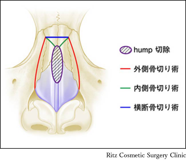 鼻骨骨切り術の３つの骨切りラインの分類　Ⅰ．外側骨切り(lateral osteotomy)　Ⅱ．内側骨切り(medial osteotomy)　Ⅲ．横断骨切り(transverse osteotomy)
