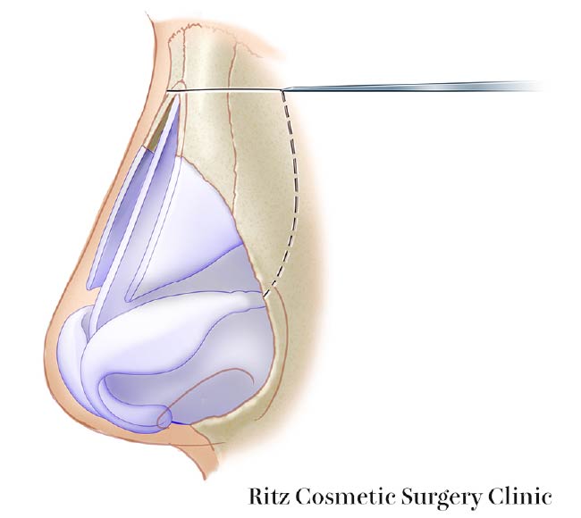 横断骨切り(transverse osteotomy)