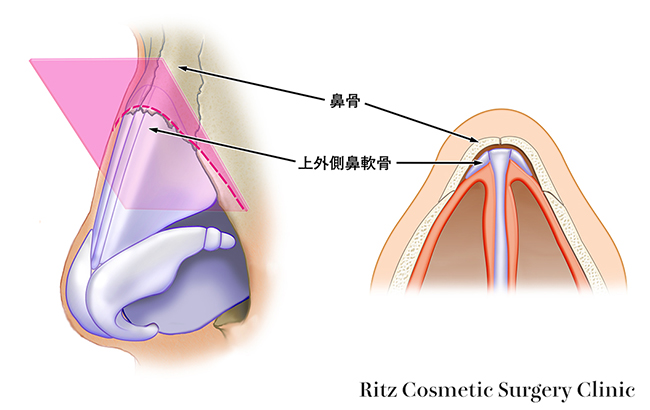 ハンプ(hump nose、段鼻