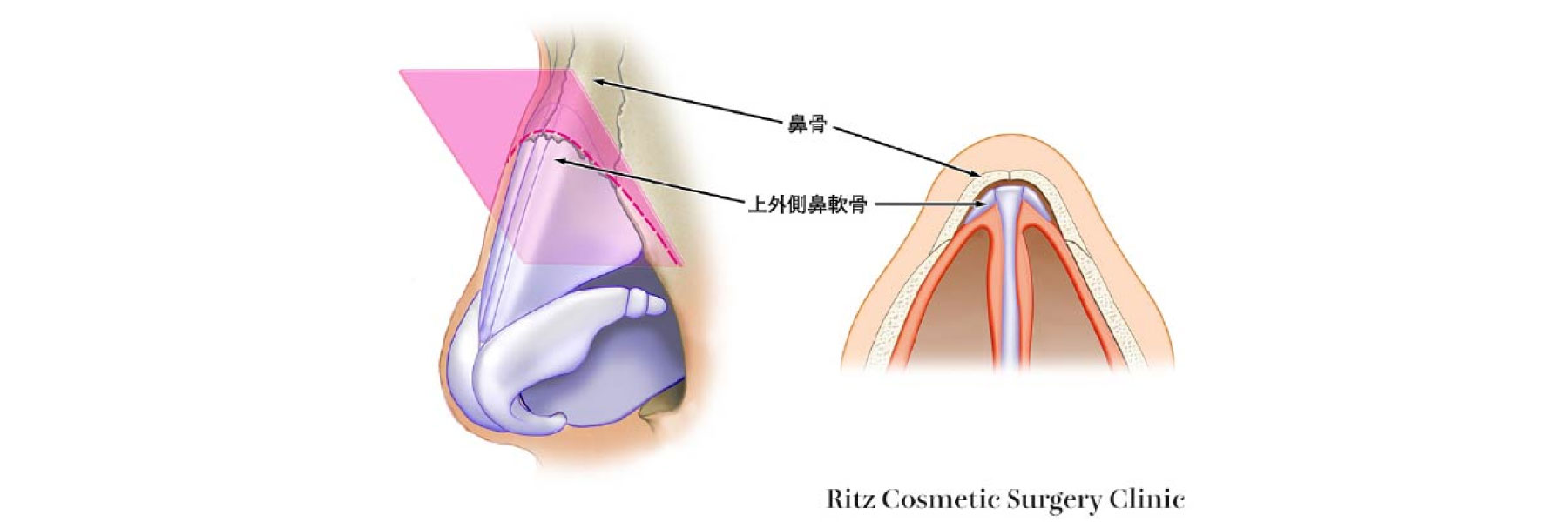 鷲鼻の出っ張り「ハンプ」