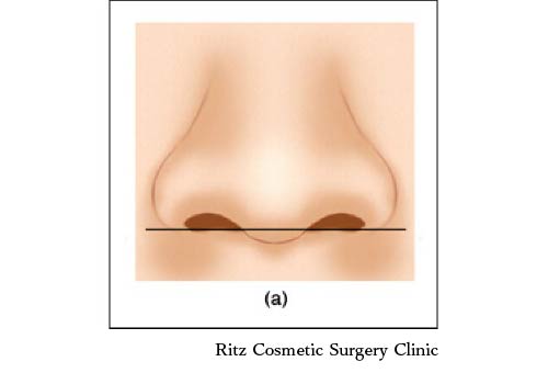 鼻翼と鼻柱との位置関係(ACR)