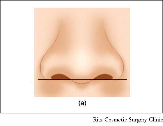 鼻翼と鼻柱との位置関係(ACR)