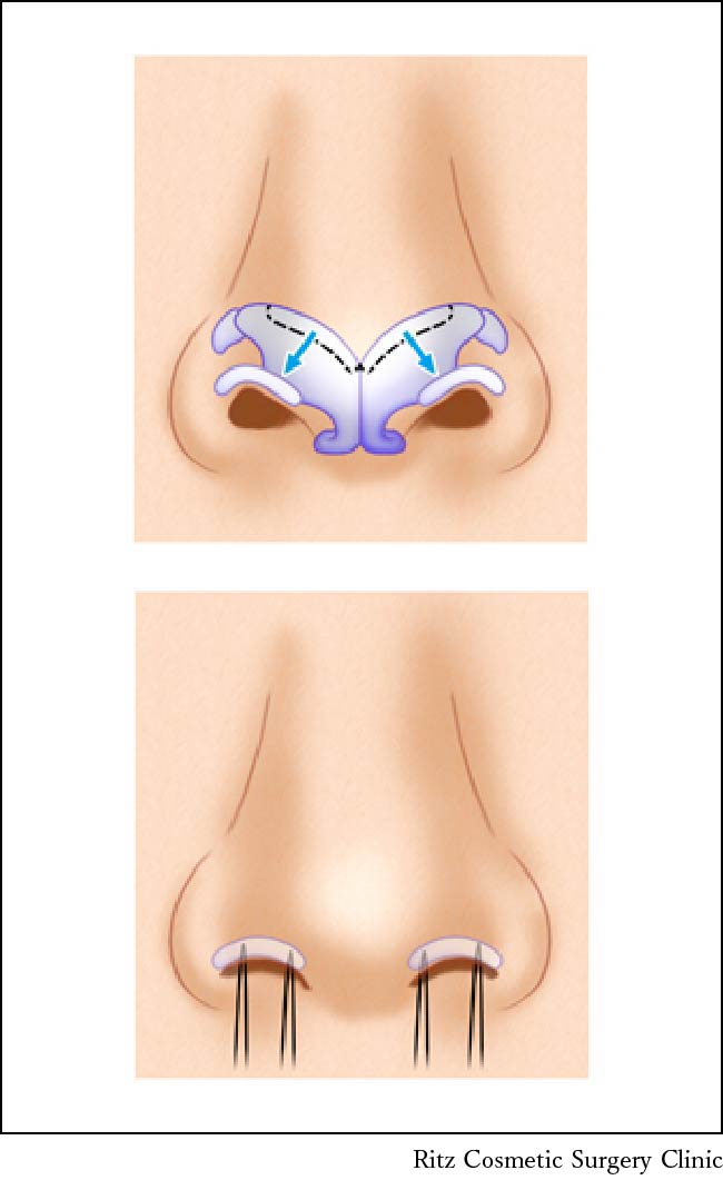 鼻孔縁鼻翼軟骨移植術