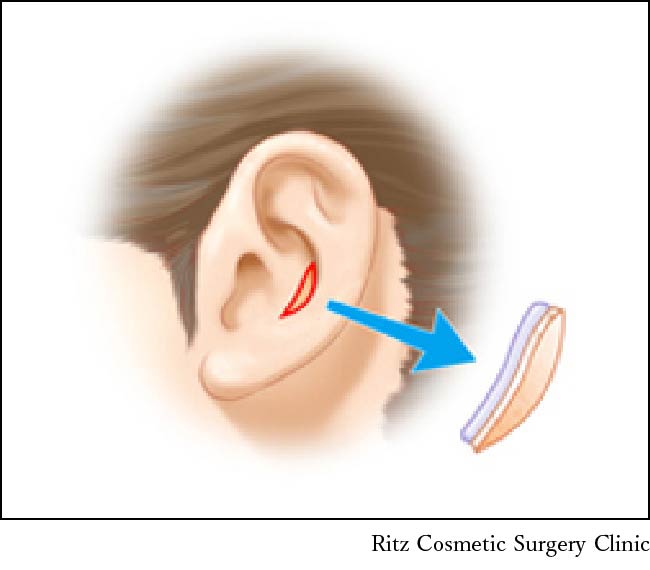 鼻孔縁複合組織移植術、耳介前面のchonchaより皮膚―軟骨複合組織片を20×5mm程度で採取