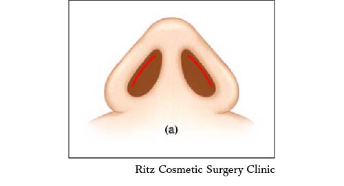 鼻孔縁複合組織移植術、鼻孔のカーブに沿うようにドナーを選択