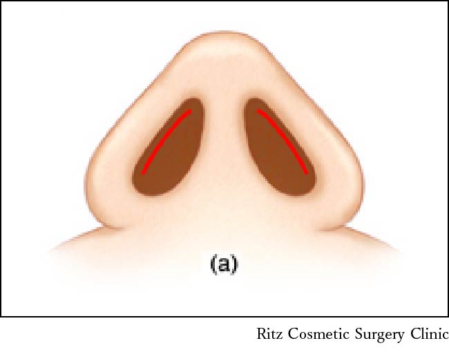 鼻孔縁複合組織移植術、鼻孔のカーブに沿うようにドナーを選択