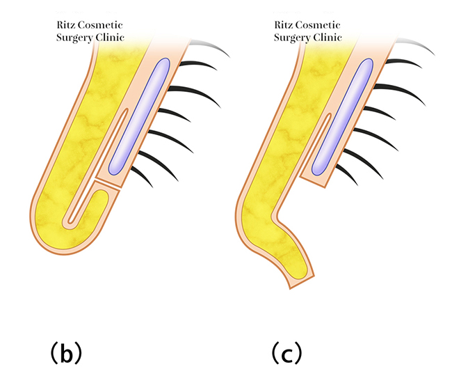 鼻孔縁複合組織移植術、鼻孔のカーブに沿うようにドナーを選択、剥離腔作成