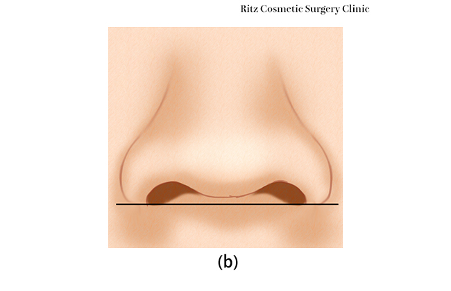 鼻翼-鼻柱関係イメージ