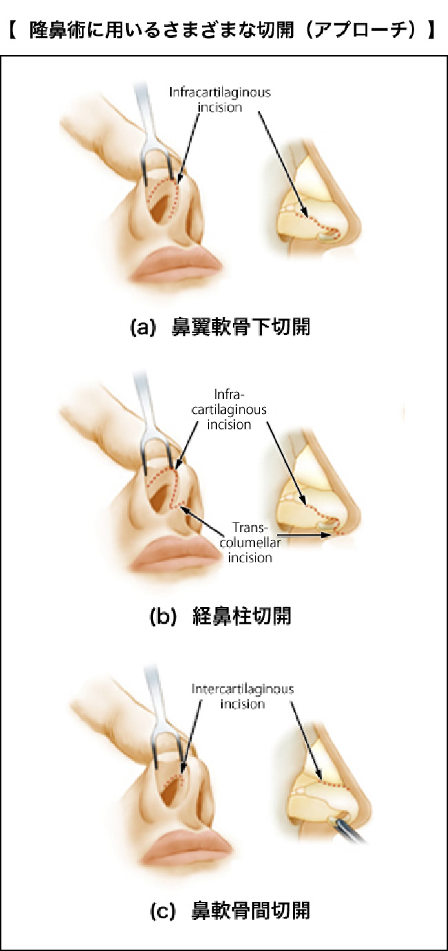 隆鼻術に用いる様々な切開（アプローチ）(a)鼻翼軟骨下切開(b)経鼻柱切開(c)鼻軟骨間切開