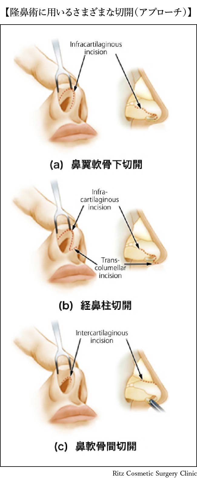 隆鼻術に用いる様々な切開（アプローチ）(a)鼻翼軟骨下切開(b)経鼻柱切開(c)鼻軟骨間切開
