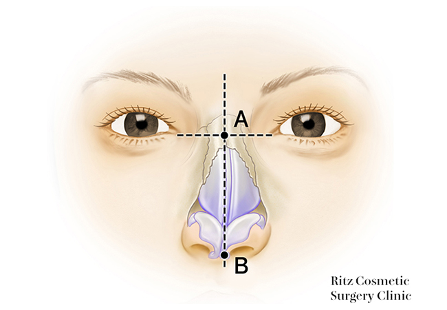 鼻根部が偏位している場合、中央線に沿って左右の剥離を均等に行う
